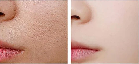 Antes y después poros